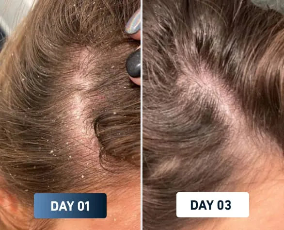 Before and after comparison of scalp condition on Day 01 and Day 03.